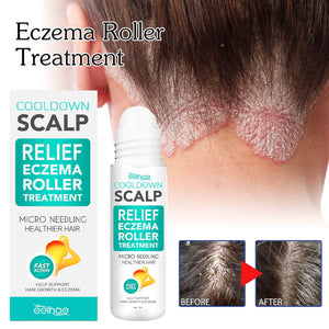 Scalp Eczema Treatment